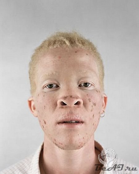 Негры альбиносы
