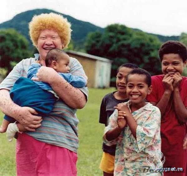 Альбинизм - дар или проклятие